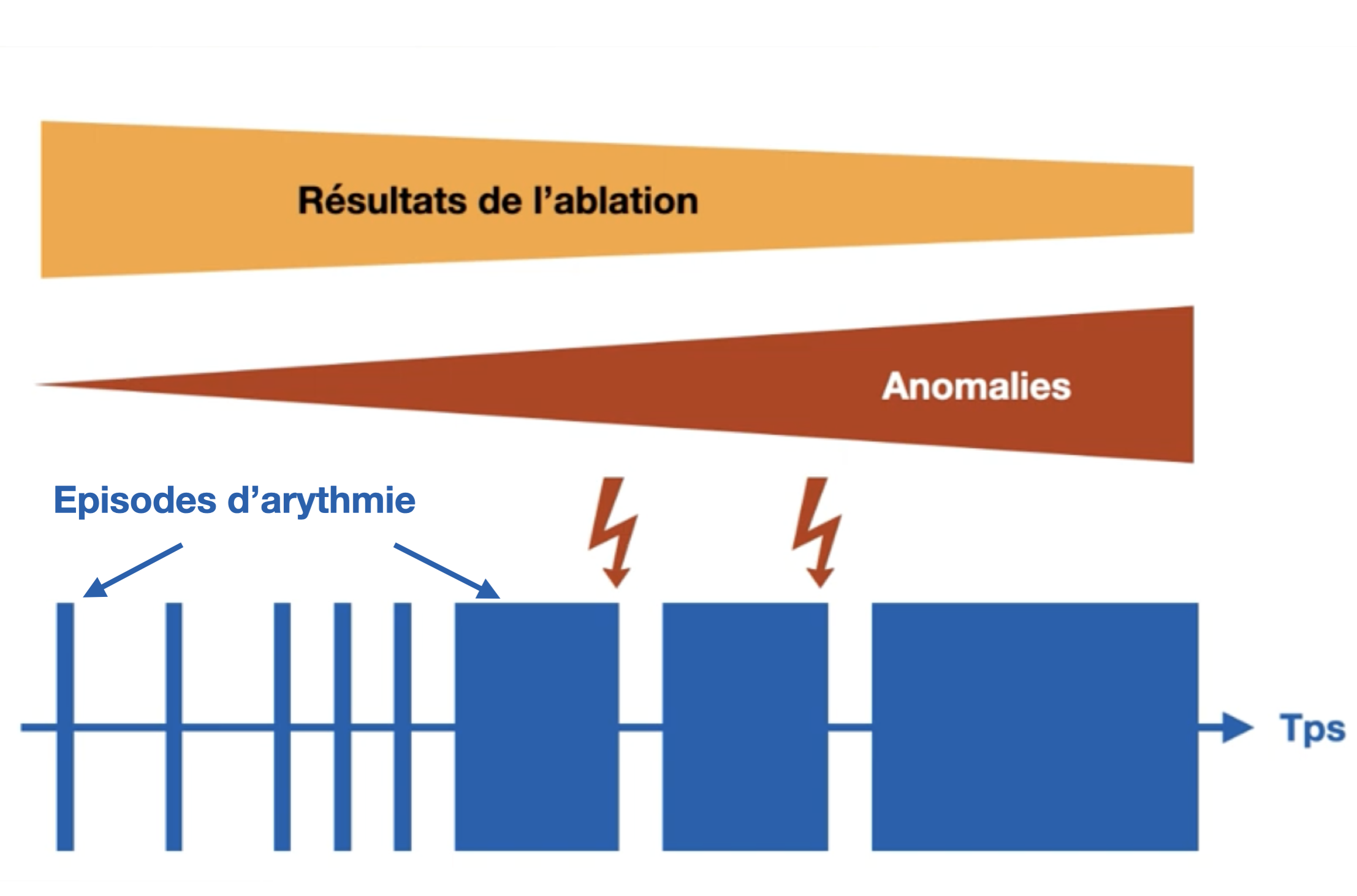 Schéma de l'évolution de la fibrillation atriale