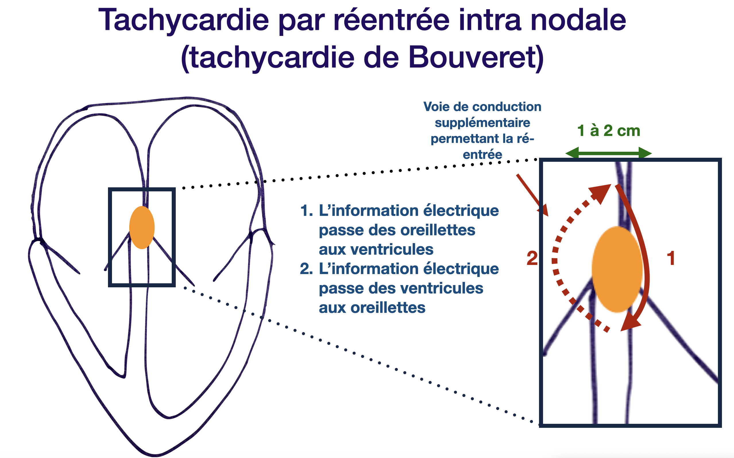 Tachycardie de Bouveret (schéma)